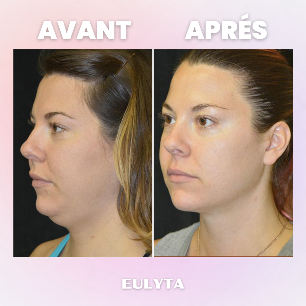 Eulyta™ Brosse Lymphatique Sculptante Visage