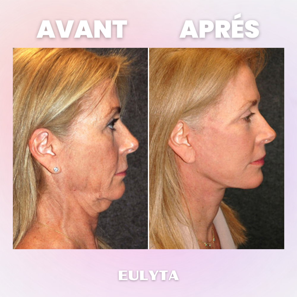 Eulyta™ Brosse Lymphatique Sculptante Visage